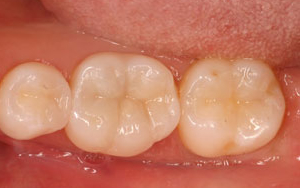 インレー料金詳細 - 田中歯科医院（春日市）