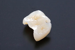 インレー料金詳細 - 田中歯科医院（春日市）